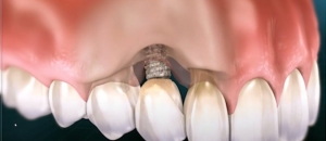 Common Causes of Dental Implant Failure Common Causes of Dental Implant Failure